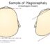 sample of plagiocephaly