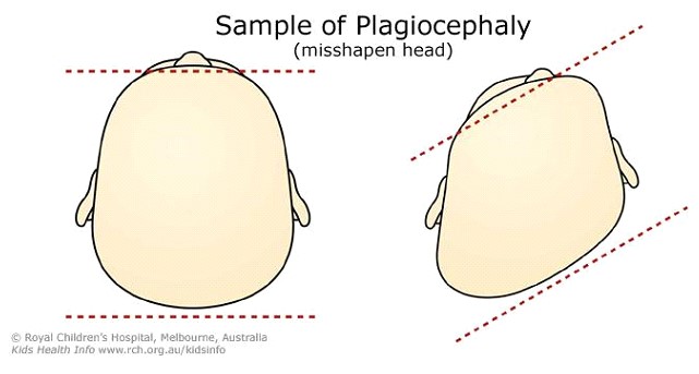 sample of plagiocephaly